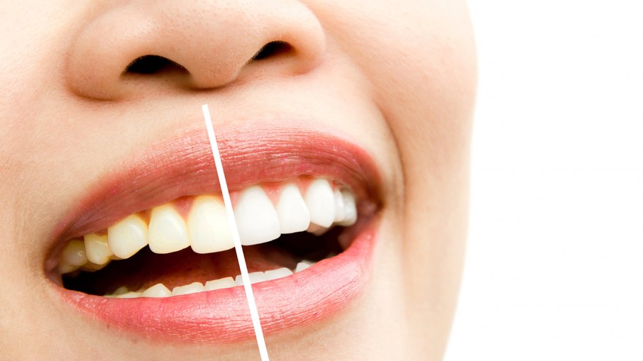 Clareamento dental causa sensibilidade