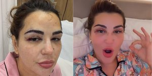 Deolane surge com hematomas no rosto e assusta web