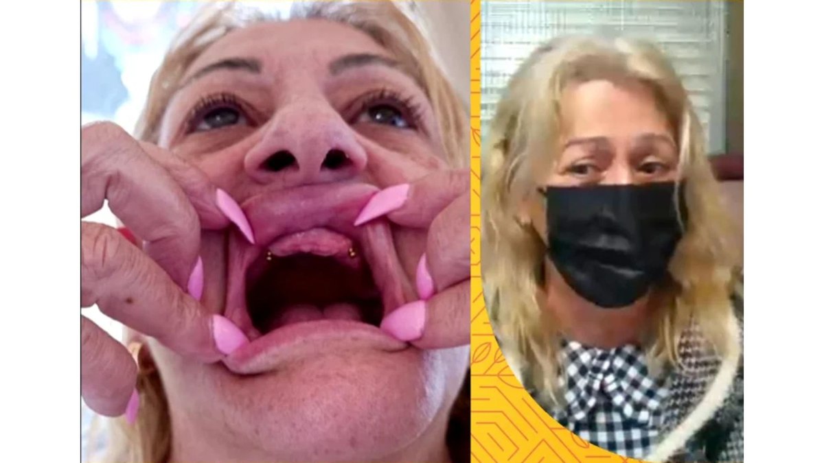 Mulher viaja para cirurgia nos seios e fica sem os dentes