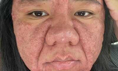 Acne gravídica: como a gravidez afeta a pele da gestante