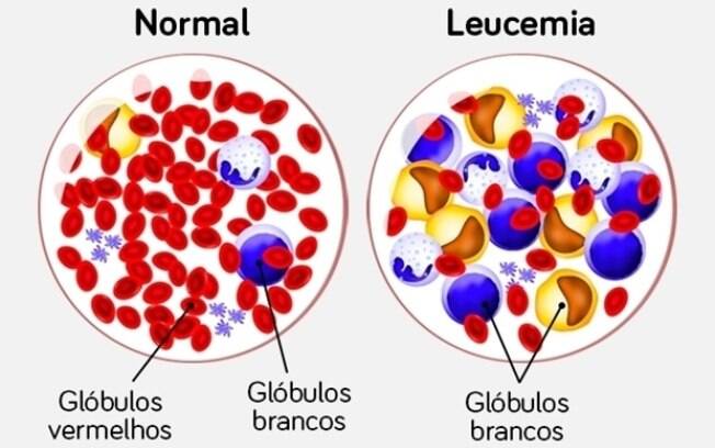 Fevereiro laranja: mês marca campanha de combate à leucemia e incentivo ao cadastro de doadores voluntários de medula óssea
