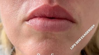 Especialista explica 4 mitos e verdades do preenchimento labial