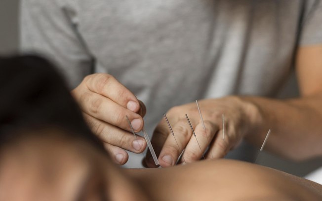 Acupuntura: PL da regulamentação tramita no Congresso