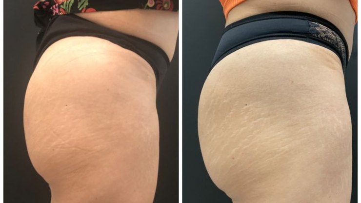 "Bumbum de colágeno": glúteos podem envelhecer sem perder volume