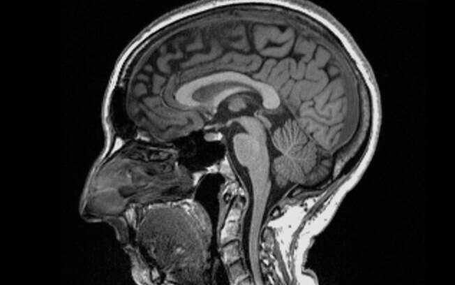 Covid: Imaging tests reveal how coronavirus infection can alter the brain