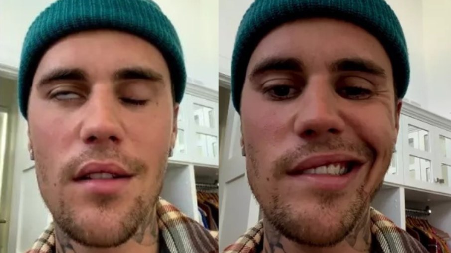 Justin Bieber com rosto paralisado
