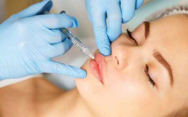 Segundo cirurgiã, correção de preenchimento labial deve ser evitada, pois o produto que dissolve ácido pode causar alergias