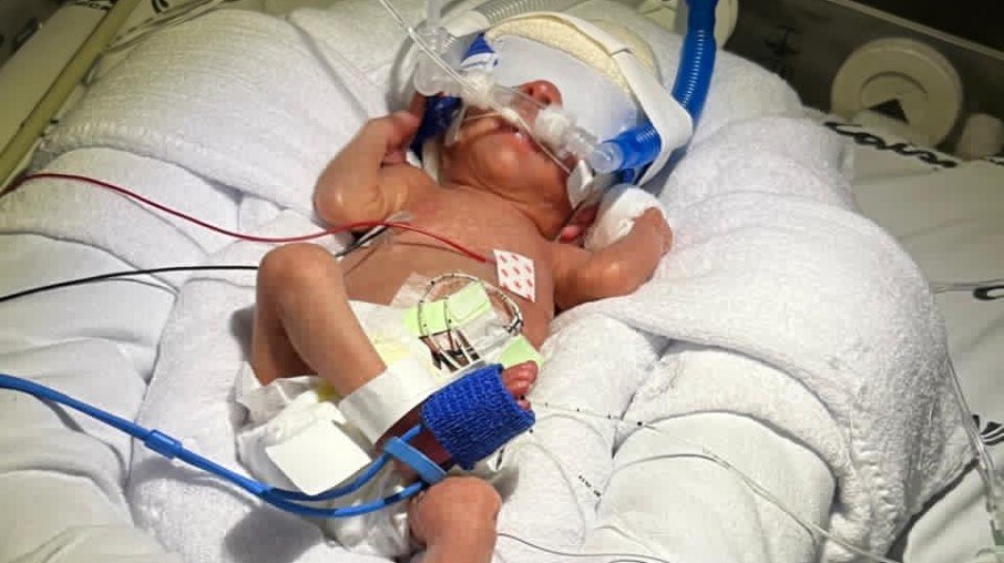 A pequena Ana Luz veio ao mundo com 29 semanas, pesando 944 gramas e medindo 36 centímetros