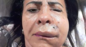 Mulher retira 40 nódulos do rosto após harmonização facial