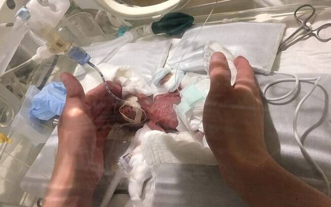 'Menor bebê do mundo' nasceu com apenas 267 gramas