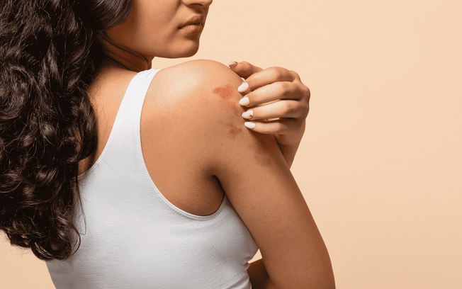 Mês da Dermatite Atópica: os impactos da doença na pele Mês da Dermatite Atópica: os impactos da doença na pele