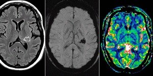 Vacina é a nova esperança contra tumores cerebrais