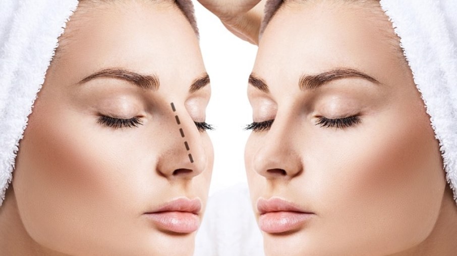 Rinoplastia estruturada combina remodelação da forma com preservação da função respiratória Rinoplastia estruturada combina remodelação da forma com preservação da função respiratória