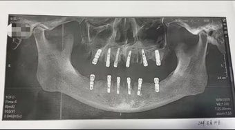 Homem morre após extrair 23 dentes e implantar outros 12