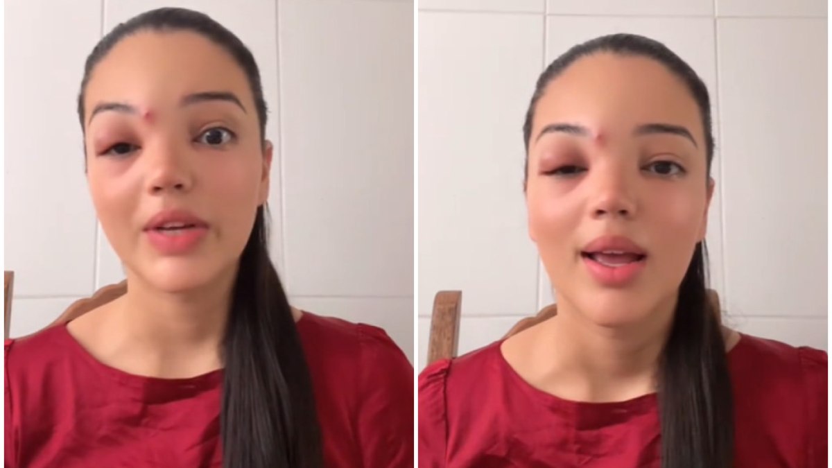 Jovem desenvolve celulite ocular após mexer em espinha.