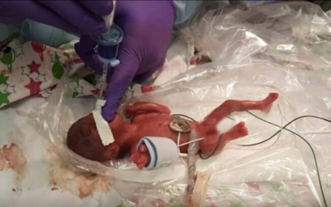 A menor bebê do mundo nasceu 