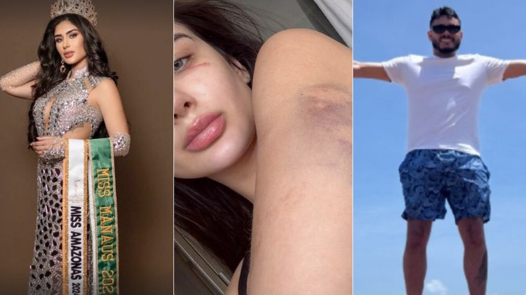 Agressor%20de%20Miss%20Amazonas%20foge%20de%20hospital%20para%20evitar%20pris%C3%A3o