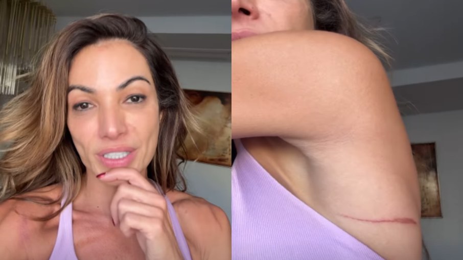 Patrícia Poeta mostra hematomas após Carnaval Patrícia Poeta mostra hematomas após Carnaval