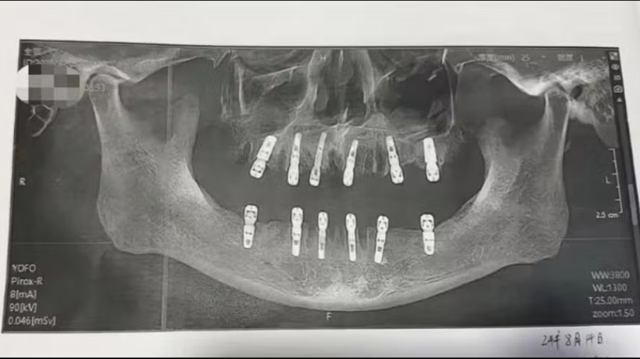 Homem morre após cirurgia para tirar 23 dentes e implantar 12