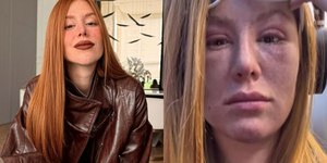 Mari Maria revela tumores abaixo dos olhos: "Achei que ia morrer"