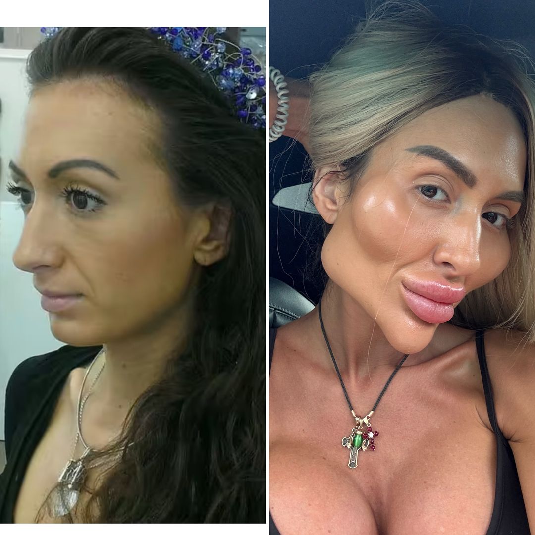 Como era Anastasia Pokreshchuk aos 25 anos, antes dos procedimentos com ácido hialurónico Reprodução/Instagram