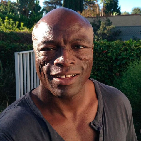Seal, por exemplo, tem marcas visíveis no rosto causadas pela doença, além de ter perdido cabelo. Em uma entrevista de 2009, contou que recebeu o diagnóstico aos 21 anos. Reprodução: Flipar