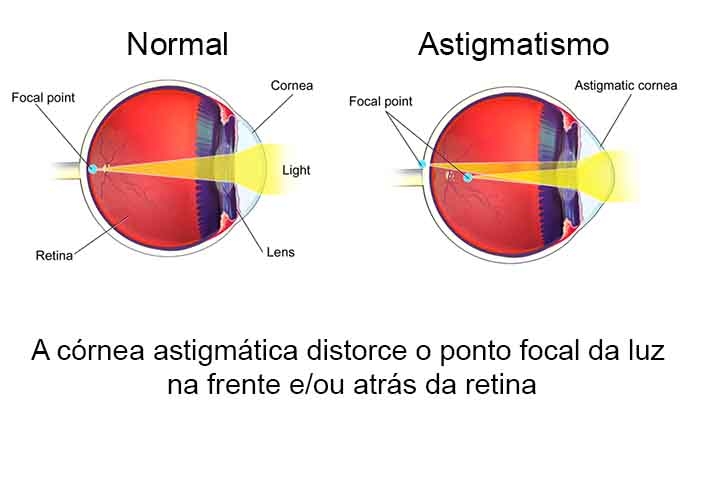 Os erros de refração, como miopia, hipermetropia, astigmatismo e presbiopia, também são causas comuns de problemas visuais. Eles ocorrem quando a luz não é corretamente focada na retina, resultando em visão embaçada. O tratamento inclui o uso de óculos ou lentes de contato e, em alguns casos, cirurgia refrativa para corrigir o problema. Reprodução: Flipar