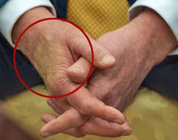 Diante dos comentários e especulações, a Casa Branca emitiu nota oficial para explicar que Trump foi diagnosticado com insuficiência venosa crônica. 
 Reprodução: Flipar