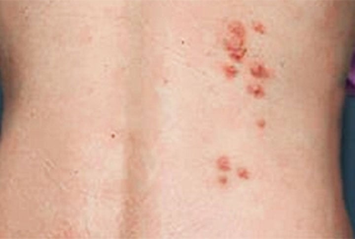 A principal consequência é a coceira intensa, com manchas vermelhas na pele. A reação pode demorar até dez dias para aparecer, o que dificulta o diagnóstico. Reprodução: Flipar