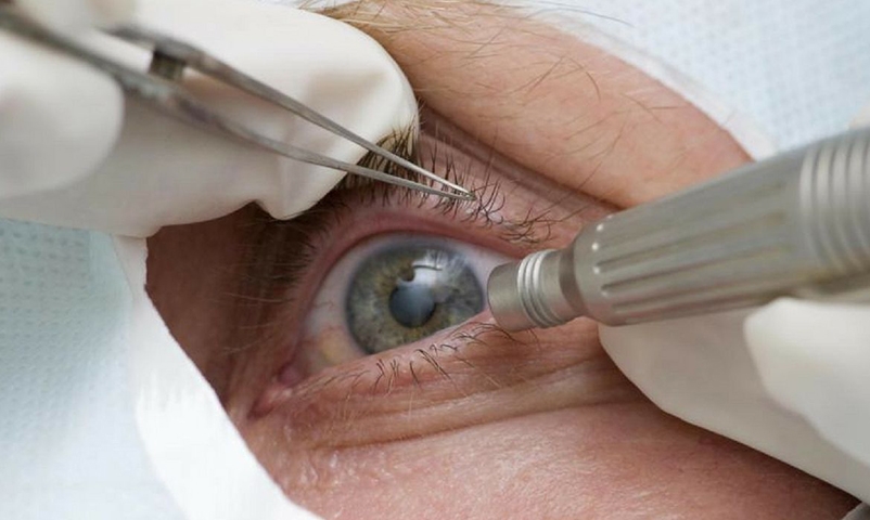A catarata pode ser tratada por meio de cirurgia, um procedimento seguro e eficaz que consiste na remoção do cristalino opaco e sua substituição por uma lente intraocular artificial. Reprodução: Flipar