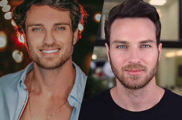 Mattar fez o procedimento na mesma clínica que atendeu ao ex-BBB Lucas Bissoli. Lucas também optou por dar uma guaribada no rosto e publicou a comparação nas redes sociais.  Reprodução: Flipar