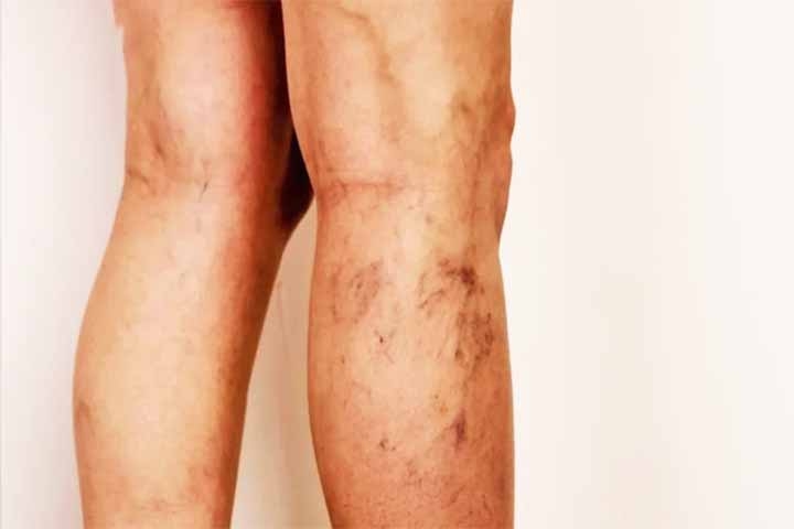 Quando essas válvulas não fecham adequadamente, o sangue tende a se acumular nas pernas e nos braços. 
 Reprodução: Flipar