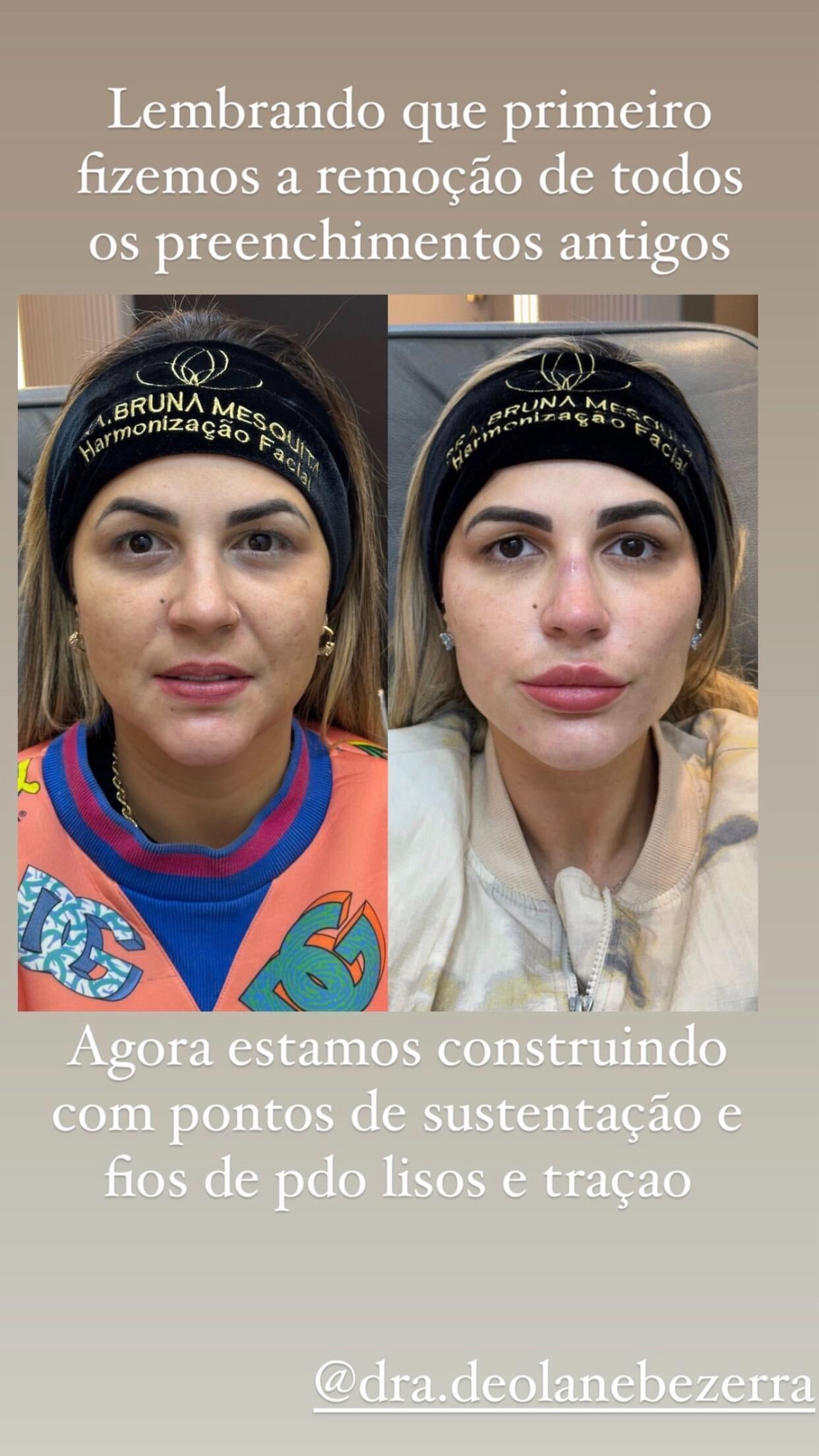 Deolane Bezerra exibe antes e depois de quase R$ 38 mil em procedimentos estéticos Reprodução/Instagram