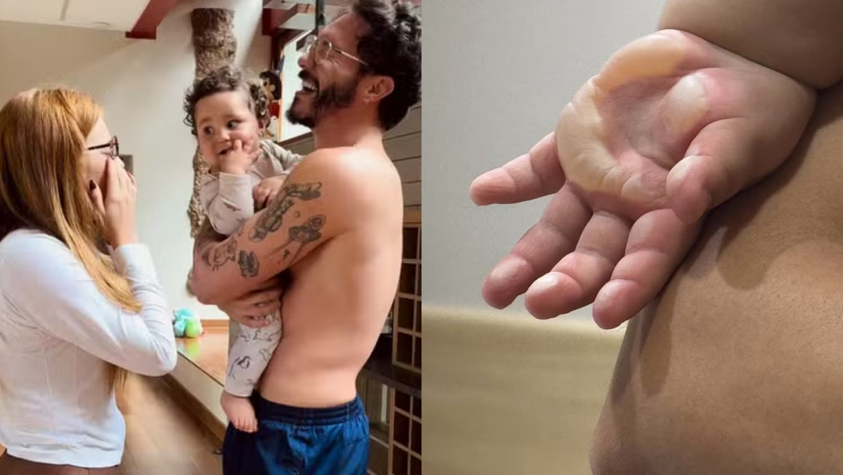 Ravi ficou com a mão queimada. Foto: Reprodução/ Instagram @viihtube