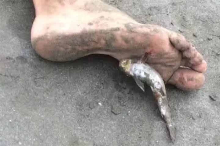 Em situações de ferimento causado pelo ferrão do bagre, a recomendação é buscar atendimento médico o mais rápido possível. 
 Reprodução: Flipar