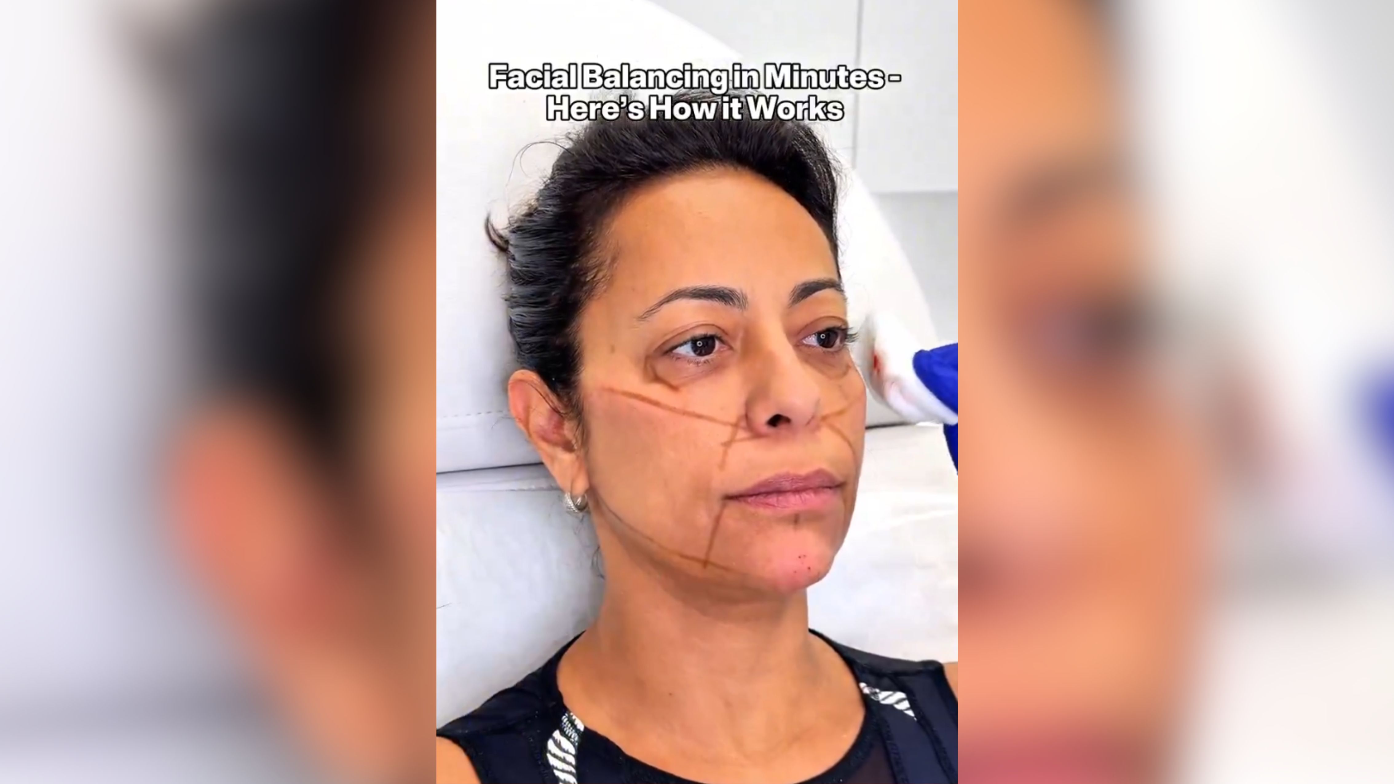 Antes e depois de Samantha após consulta com médico da Kardashian. Foto: X/@simonourianmd