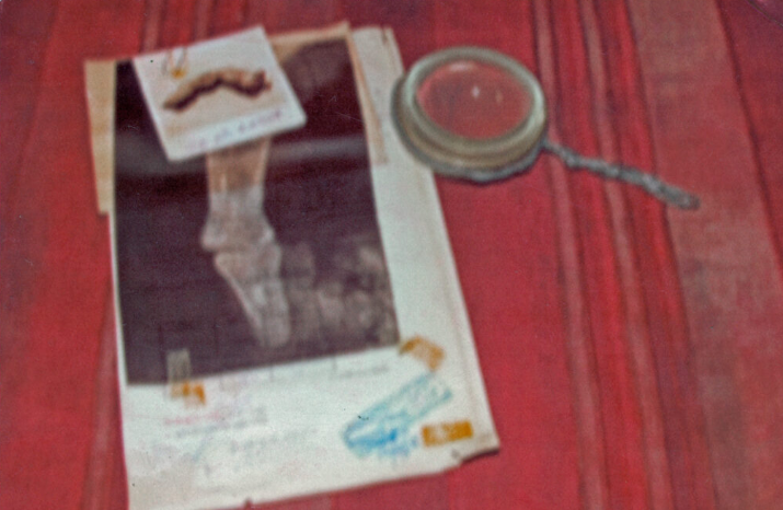 Foto polaroid e radiografia do dedo tirada na década de 1960 Reprodução