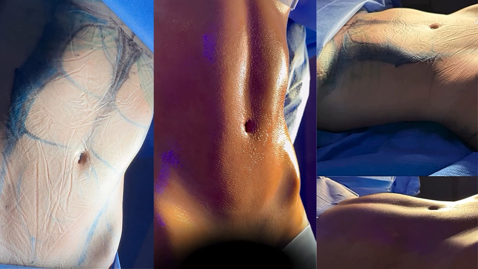Antes e depois de lipoaspiração de Karoline Lima Reprodução/Instagram - 02.02.2024