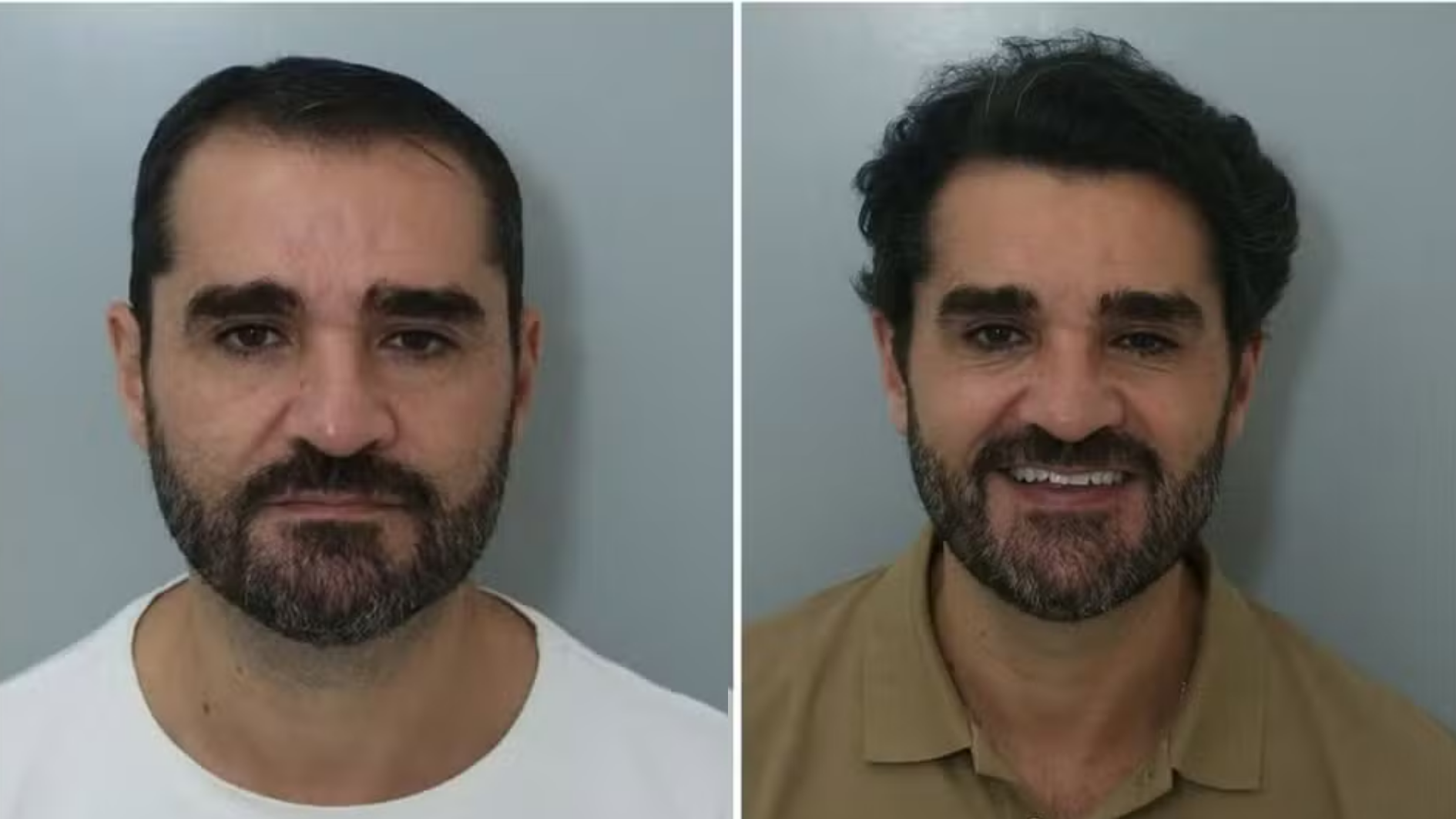 Apresentador da GloboNews faz transplante capilar veja antes e depois. Foto: Reprodução