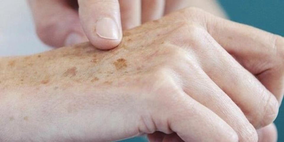 O melanoma (tipo mais grave de câncer)  aparece nos melanócitos, células responsáveis pela melanina, a pigmentação (cor) da pele. Desde que não haja metástase (quando o câncer se espalha para outras partes do corpo), a chance de cura beira os 95%. Já com metástase, as chances de cura rondam os 15%.   Reprodução: Flipar