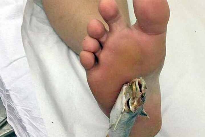 O contato com a pele humana pode provocar ferimentos dolorosos e inflamações, e já há relatos de pessoas machucadas em decorrência desse tipo de acidente na região.  Reprodução: Flipar