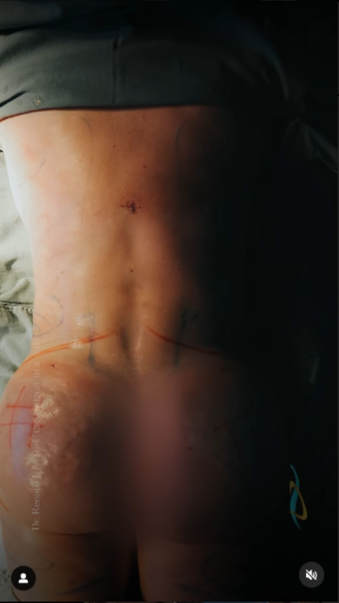 Modelo mostra cicatrizes após mamoplastia, abdominoplastia e lipoaspiração Instagram