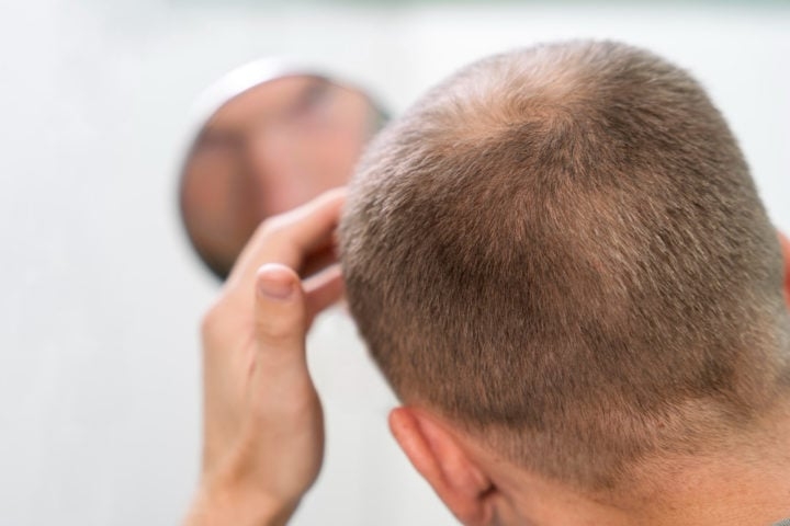 Embora não recuperem completamente o cabelo perdido, medicamentos como finasterida e minoxidil são eficazes para evitar a piora da queda, especialmente em homens. Mas exigem cuidado.  Reprodução: Flipar