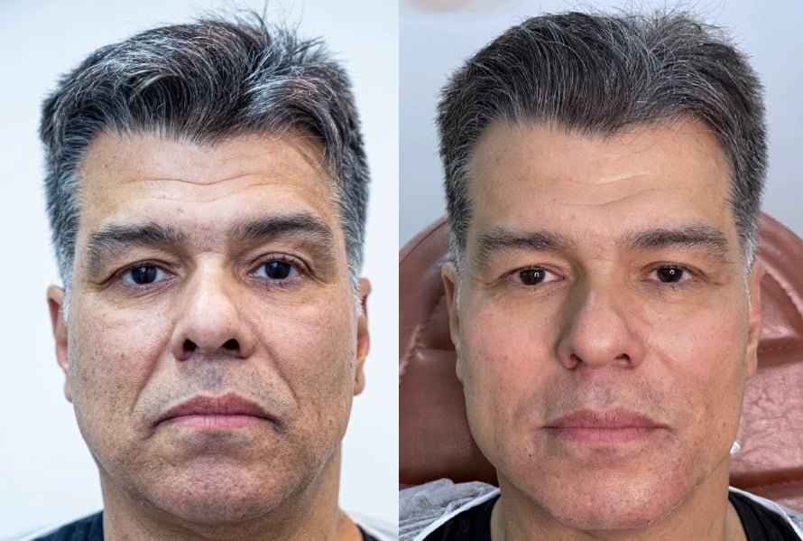 O ator carioca Maurício Mattar fez harmonização em julho de 2022 e comemorou o resultado.  Ele achou que a suavização deu certo e postou a comparação em suas redes sociais.  Reprodução: Flipar