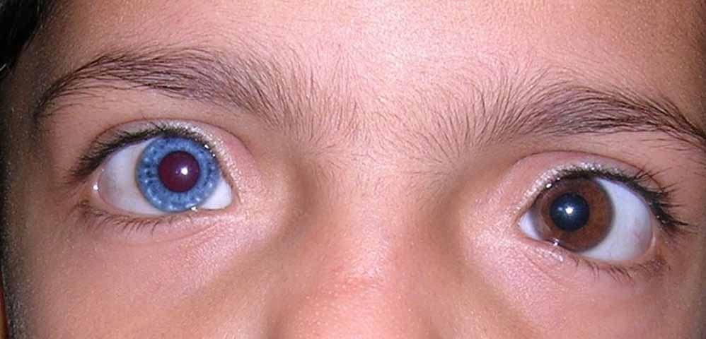 A heterocromia pode ocorrer de duas formas principais: a heterocromia completa, quando cada olho tem uma cor diferente - por exemplo, um azul e outro castanho - e a heterocromia parcial, quando um mesmo olho tem duas cores distintas, como uma mancha de outra cor dentro da íris.


 Reprodução: Flipar
