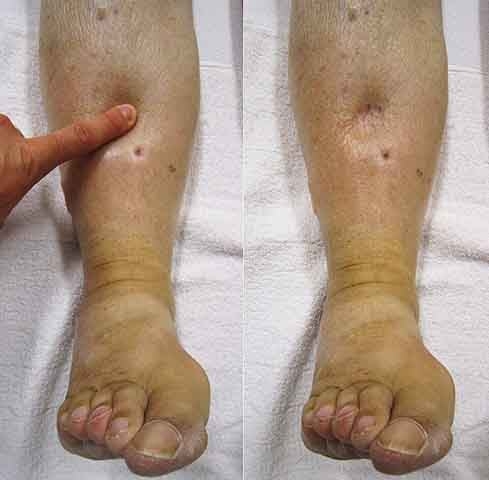 Em entrevista ao jornal “The New York Times”, Prakash Krishnan, diretor de serviços endovasculares do Hospital Cardíaco Mount Sinai, destacou que, quando o retorno do sangue ao coração é dificultado, as veias se dilatam, ocasionando inchaço, desconforto e, em casos crônicos, escurecimento da pele e até feridas. 
 Reprodução: Flipar