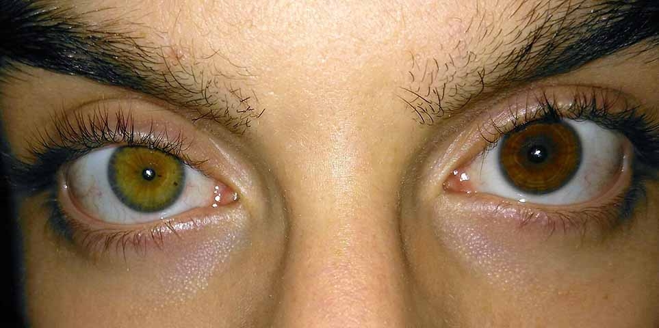 A heterocromia pode ser congênita - presente desde o nascimento - ou adquirida, causada por traumas, doenças ou uso de certos medicamentos. Em muitos casos, especialmente quando congênita, é apenas uma característica estética e não afeta a visão. Algumas pessoas famosas têm heterocromia e talvez você não saiba. Confira a seguir!
 Reprodução: Flipar
