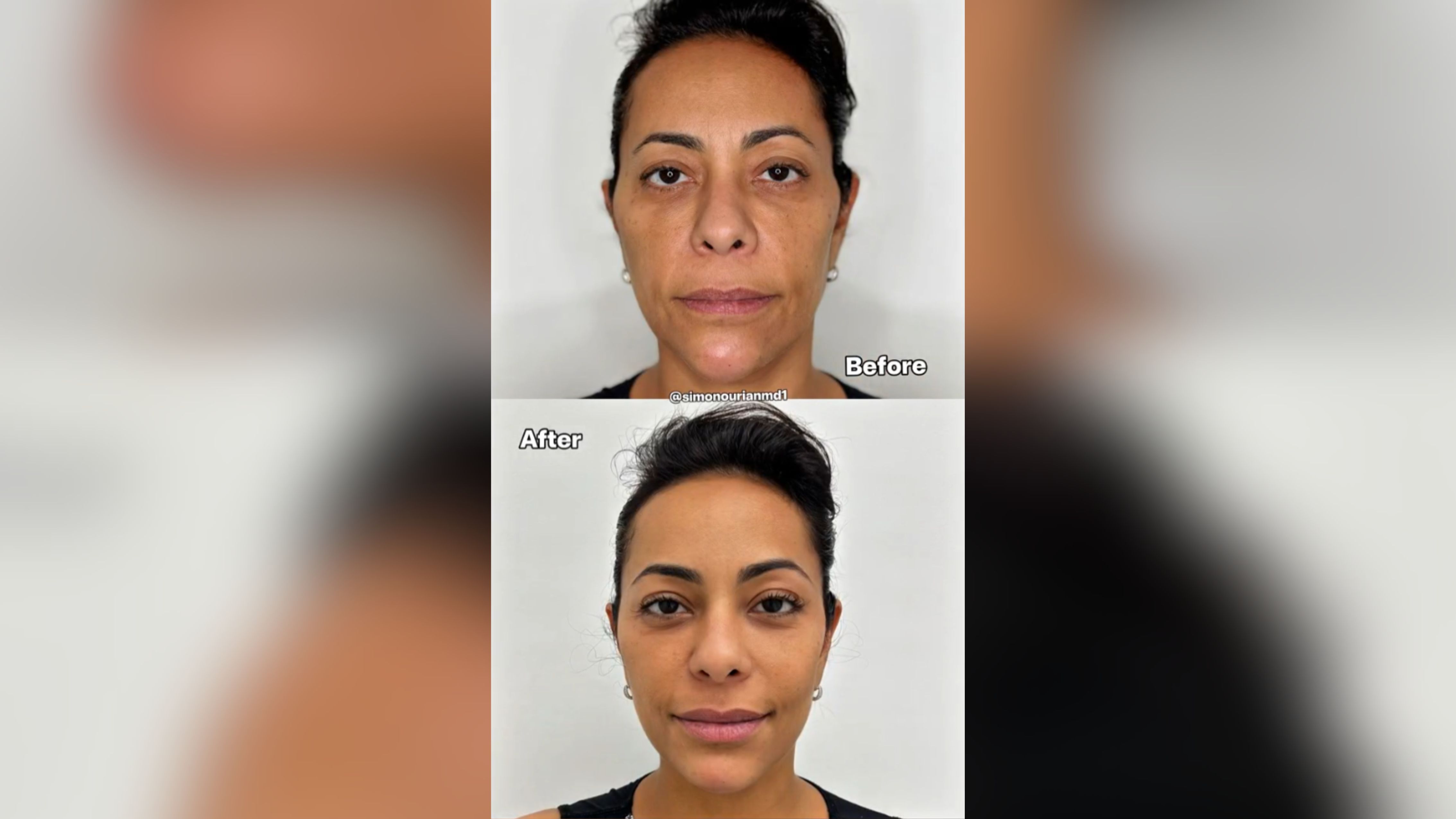 Antes e depois de frente da Samantha Schmütz. Foto: X/@simonourianmd