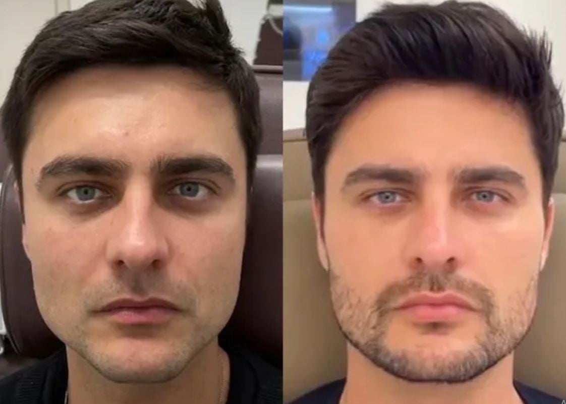 O ator gaúcho Guilherme Leicam fez preenchimento na mandíbula, malar, nariz, orelhas, queixo e têmpora, além da aplicação de toxina botulínica no rosto todo.  Reprodução: Flipar
