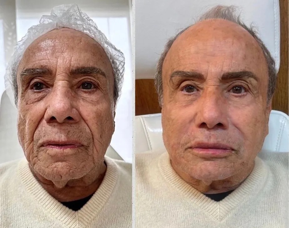 Stênio Garcia revela o antes e o depois da harmonização facial. Foto: Divulgação